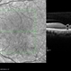 Vitreomacular Traction