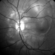Preeclampsia in a 30-Year-Old  - Red Free Photograph - LE Preeclampsia in a 30-Year-Old  - Red Free Photograph - LE