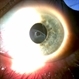 Dislocated Intraocular Lens Dislocated Intraocular Lens