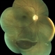 Retinal Detachment Retinal Detachment