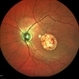 Central Areolar Choroidal Dystrophy Central Areolar Choroidal Dystrophy
