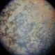 Retinitis Pigmentosa (RP)