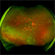 Wyburn-Mason Widefield Fundus Photography