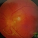 Ocular Trichuriasis