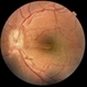 Macular Fold Macular Fold