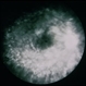 Necrotizing Retinitis Necrotizing Retinitis