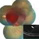 Large Sub-ILM Macular Hemorrhage Large Sub-ILM Macular Hemorrhage