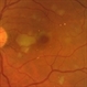 Multiple Branch Retinal Artery Occlusion ( BRAO) Multiple Branch Retinal Artery Occlusion ( BRAO)