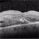 OCT Confirming the Full Thickness Macular Fold OCT Confirming the Full Thickness Macular Fold