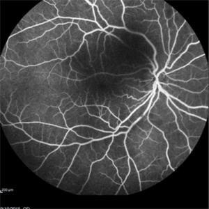 Sickle Cell Retinopathy Retina Image Bank   Image Square;max$300,300.ImageHandler