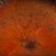 Central Retinal Vein Occlusion with Macular Edema Central Retinal Vein Occlusion with Macular Edema