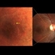DUSN (Diffuse Unilateral Subacute Neuroretinitis) DUSN (Diffuse Unilateral Subacute Neuroretinitis)