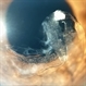 Capsular Bag Dislocation into the Anterior Chamber Capsular Bag Dislocation into the Anterior Chamber