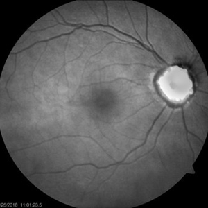 Optic Disc Drusen - Retina Image Bank