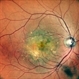 SUB-RETINAL NEOVASCULAR MEMBRANE SUB-RETINAL NEOVASCULAR MEMBRANE