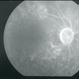 Syphilitic Chorioretinitis Syphilitic Chorioretinitis