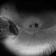 Choroidal Melanoma with Exudative Detachment Choroidal Melanoma with Exudative Detachment