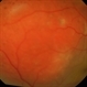 Diffuse Choroidal Hemangioma Diffuse Choroidal Hemangioma