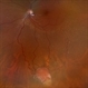Von Hippel-Lindau Syndrome Von Hippel-Lindau Syndrome