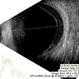 Subhyaloid Haemorrhage Subhyaloid Haemorrhage