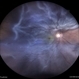 Sub-total Retinal Detachment Sub-total Retinal Detachment