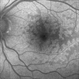 Paracentral Acute Middle Maculopathy Paracentral Acute Middle Maculopathy