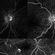 Active Proliferative Diabetic Retinopathy Active Proliferative Diabetic Retinopathy