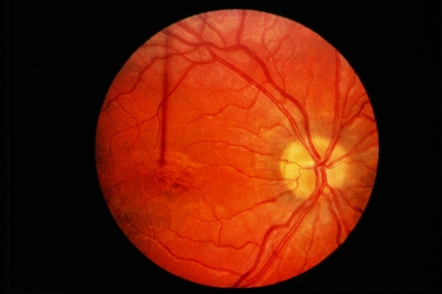 Pseudotumor Cerebri - Retina Image Bank