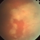 Acute Retinal Necrosis Acute Retinal Necrosis