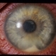 HLA-B27 Associated Uveitis