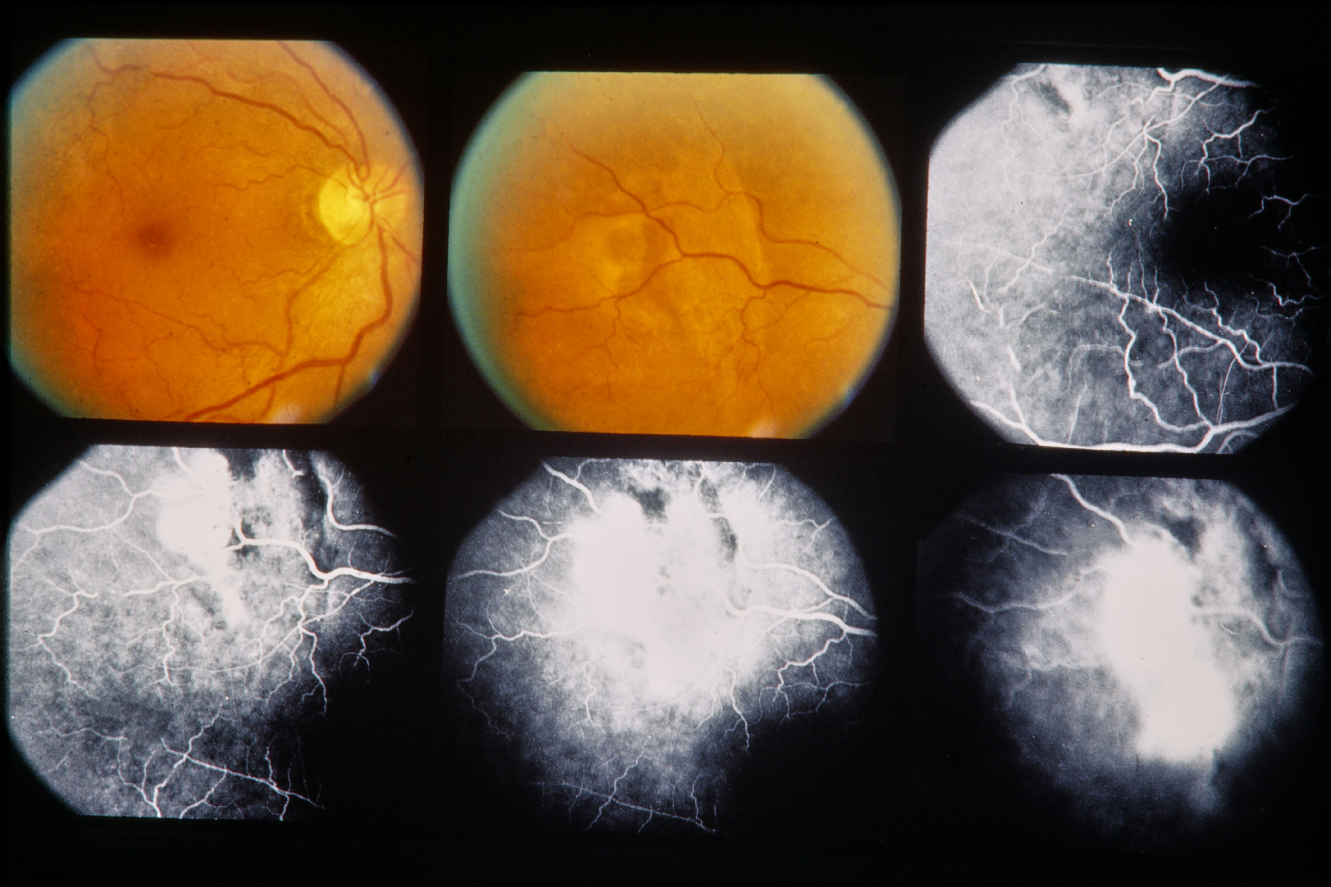 hole in retina and cancer meds
