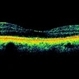 Subfoveal Bleed From Extramacular CNVM Subfoveal Bleed From Extramacular CNVM