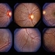 Fundus Albipunctatus Fundus Albipunctatus