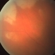 Acute Retinal Necrosis Acute Retinal Necrosis