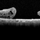 Chronic Full Thickness Macular Hole