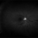 Central Retinal Artery Occlusion Central Retinal Artery Occlusion