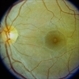 Central Serous Chorioretinopathy (CSR)