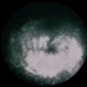 Necrotizing Retinitis Necrotizing Retinitis