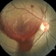 Subhyaloid Hemorrhage - Post Hyaloidotomy Subhyaloid Hemorrhage - Post Hyaloidotomy