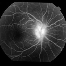 Neuroretinitis - Retina Image Bank