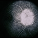 Congenital Disc Anomaly Congenital Disc Anomaly