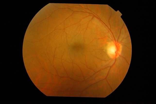 Large Traumatic Retinal Tear - Retina Image Bank