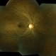 Fundus Albipunctatus OD Fundus Albipunctatus OD