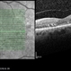 Diabetic Macular Edema Post One Intravitreal Anti-VEGF Dose