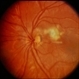 Peripapillary CNVM / Uveitis Peripapillary CNVM / Uveitis