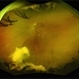 Vasoproliferative Tumor Vasoproliferative Tumor