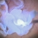 Intraoperative Triamcinolone Staining to Visualize Hyaloid Intraoperative Triamcinolone Staining to Visualize Hyaloid