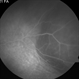 Scleritis Scleritis
