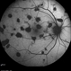 Healed Choroiditis Healed Choroiditis