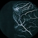 Combined Retinal / RPE Hamartoma Combined Retinal / RPE Hamartoma